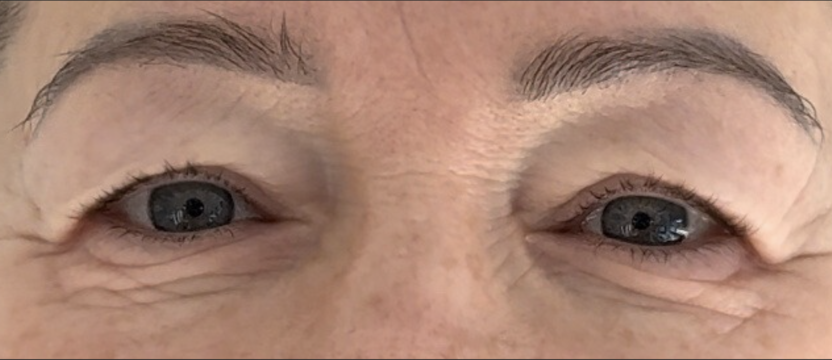 Blefaroplastyka przed zabiegiem - pacjent 1