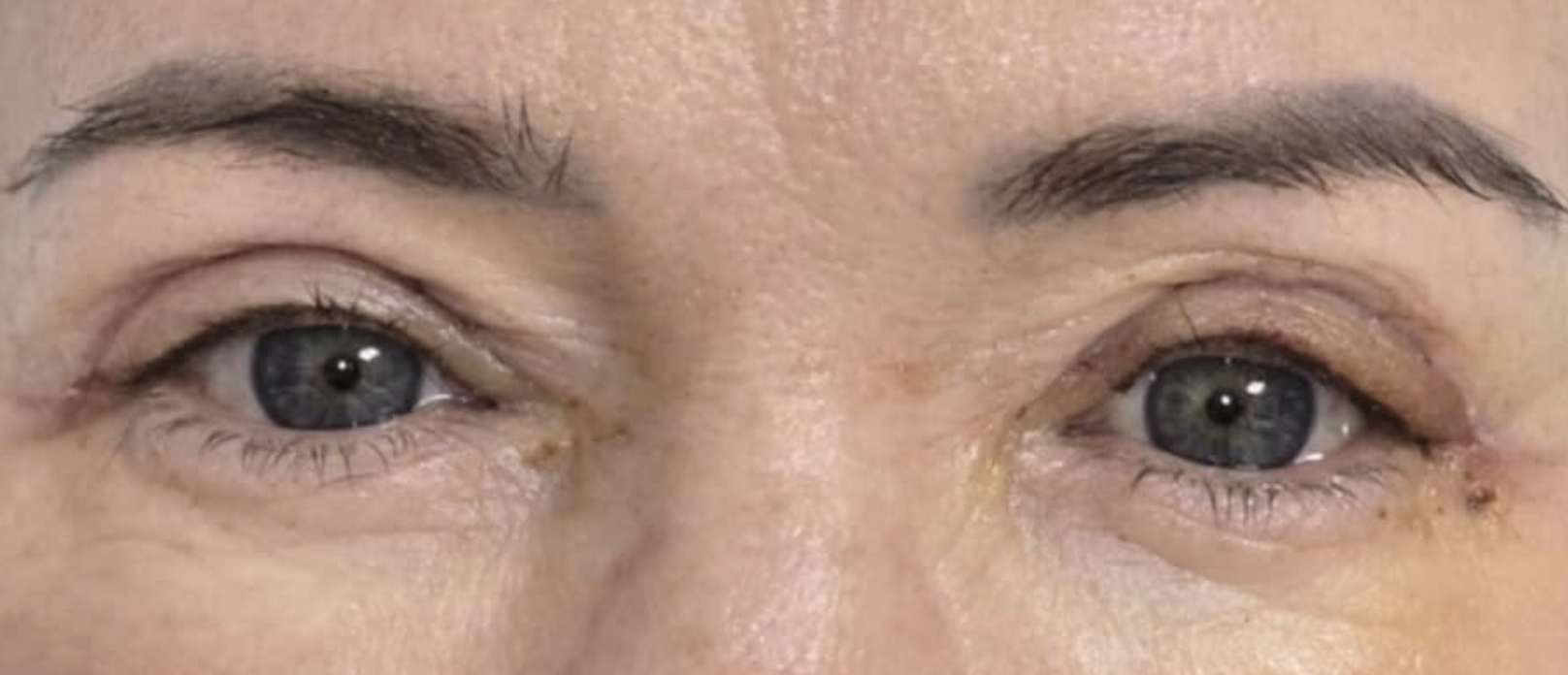 Blefaroplastyka po zabiegu - pacjent 1